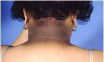 acantosis.jpg