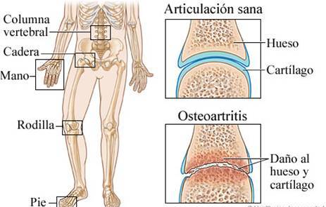 osteoar.jpg