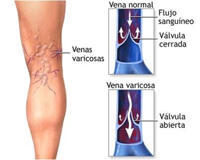 varices.jpg